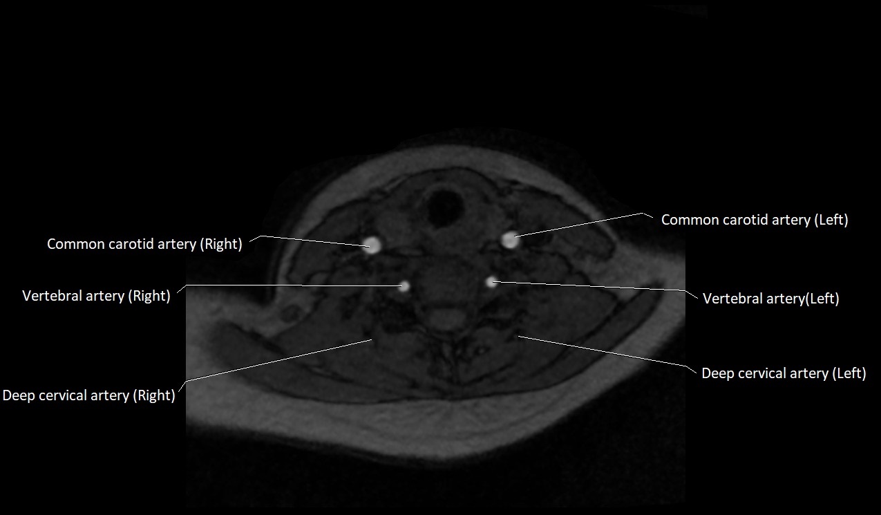 Carotid artery anatomy axial 3T image 47.jpg